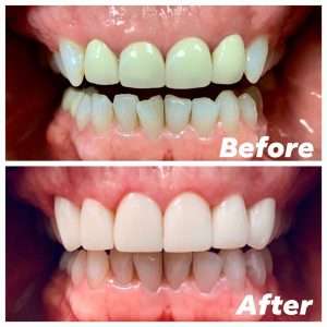 Lexington Dental Before and After 08